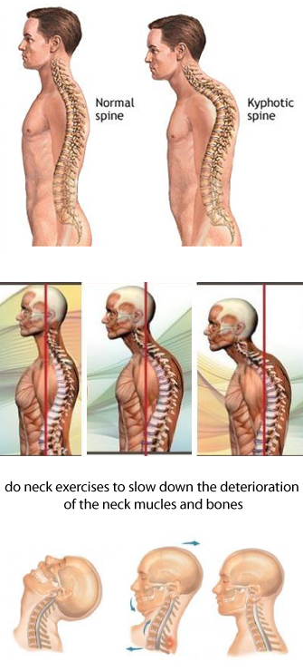 Neck Problems in Yogi